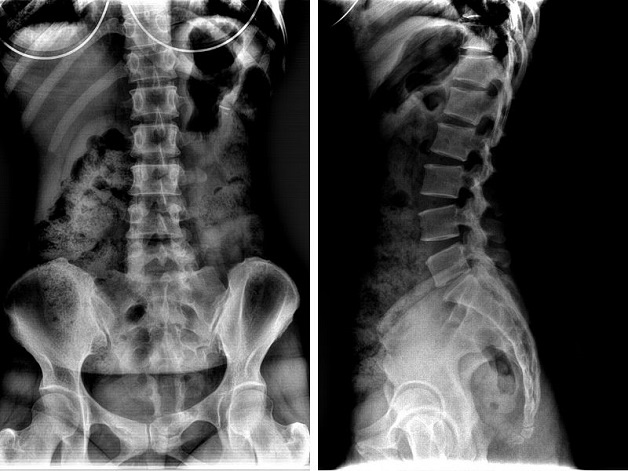 Chụp x quang cột sống khi nào? Phát hiện bệnh gì?