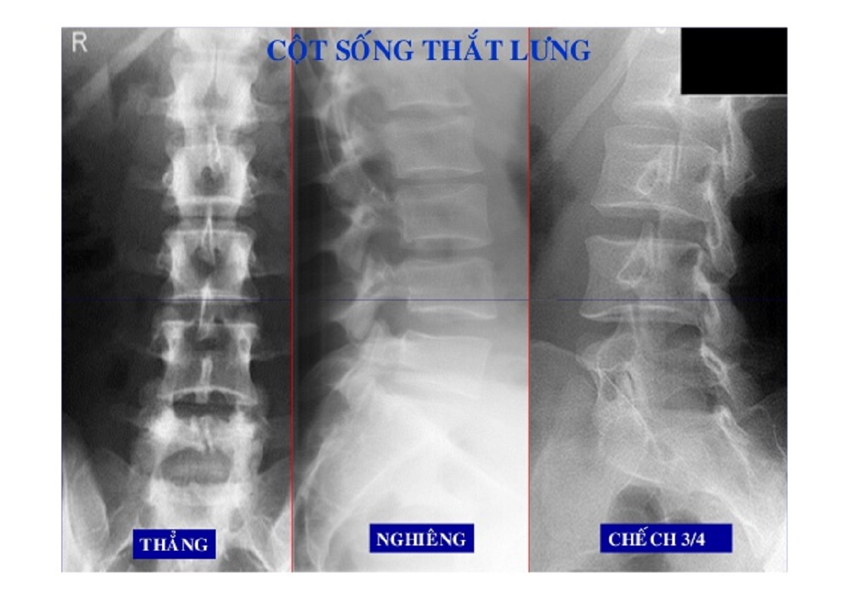 Chụp X-quang cột sống thắt lưng phát hiện bệnh gì?