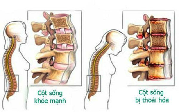 Chụp X-quang cột sống thắt lưng phát hiện bệnh gì?