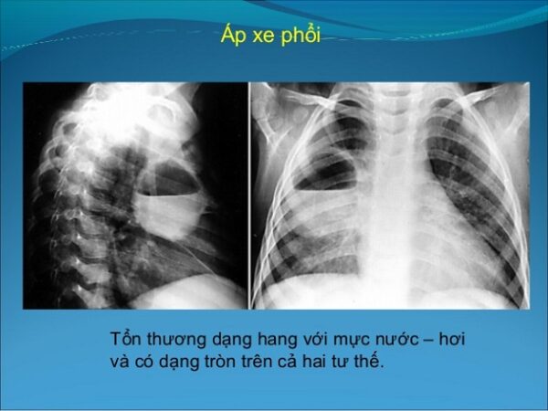 Chụp X quang phổi giúp chẩn đoán nhiều bệnh nguy hiểm