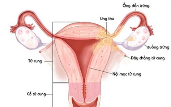 Chụp X quang tử cung vòi trứng