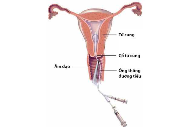 Chụp X quang vòi trứng cần lưu ý những gì?