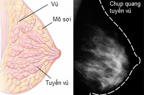 Chụp X quang vú ở đâu TỐT và Kết quả Chuẩn nhất?