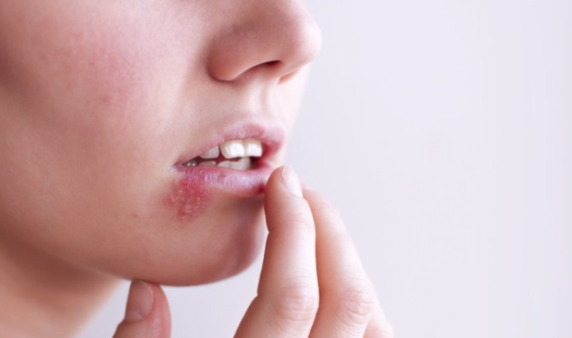 Chuyên gia giải đáp: Bệnh herpes môi có lây không?