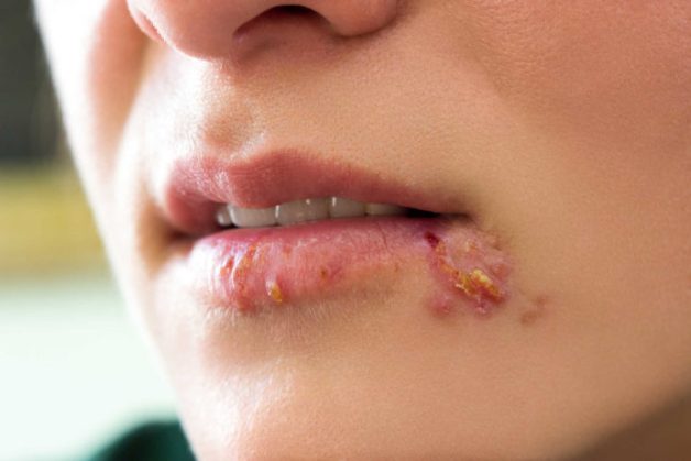 Chuyên gia giải đáp: Bệnh Herpes môi có nguy hiểm không?