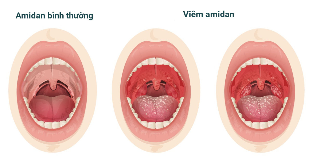 Chuyên gia giải đáp: Có nên cắt amidan cho trẻ?