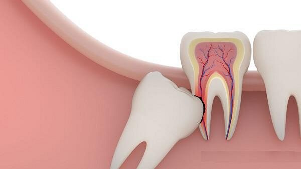 Chuyên gia giải đáp: Nhổ răng khôn có bị gì không?