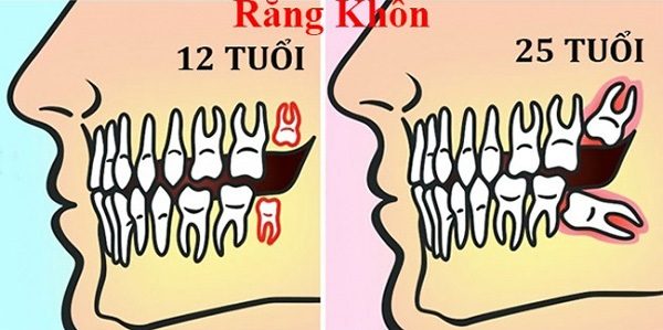 Chuyên gia giải đáp: Nhổ răng khôn có bị gì không?