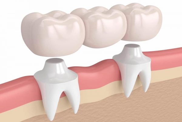 Chuyên gia giải đáp: Trồng 1 cái răng bao nhiêu tiền?