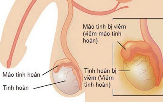 Chuyên gia giải đáp: Viêm tinh hoàn có nguy hiểm không?