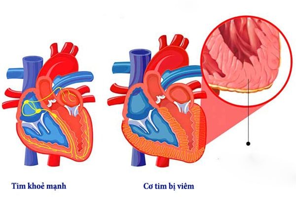 Chuyên gia Tim mạch giải đáp: Bệnh viêm cơ tim có lây không?