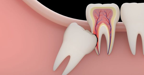 Có bao nhiêu răng số 8 trên cung hàm người trưởng thành?