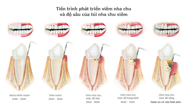 Có các biện pháp nào giúp điều trị viêm nha chu nặng?