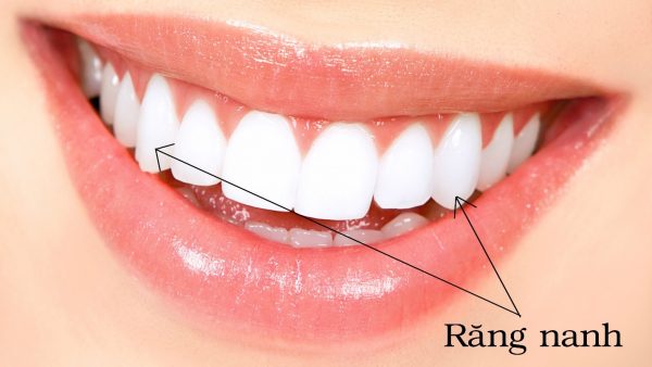 Có cần thiết phải trồng răng nanh không?