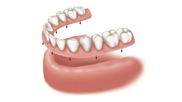 Có cần thiết phải trồng răng nanh không?