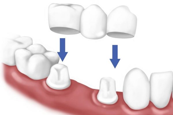 Có cần thiết phải trồng răng nanh không?