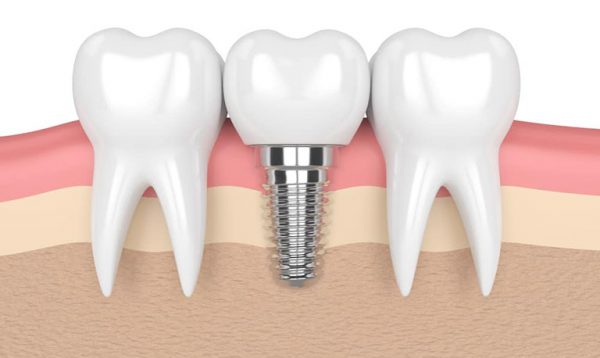 Có cần thiết phải trồng răng nanh không?