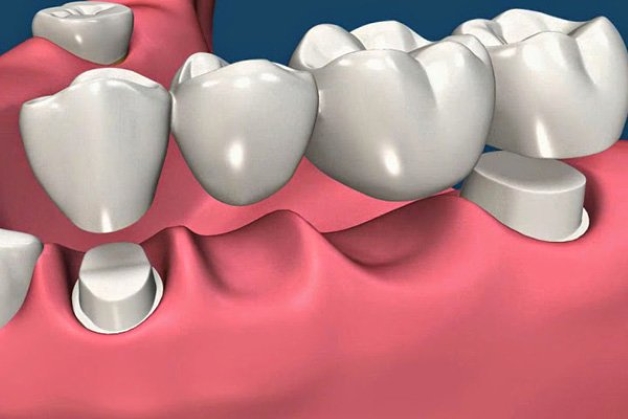 Có cần trồng lại nếu mất răng số 7 không?