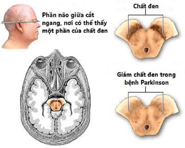 Cơ chế bệnh parkinson và rối loạn đường tiểu