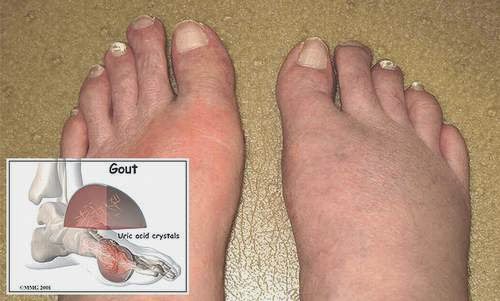 Cơ chế bệnh sinh của bệnh gout