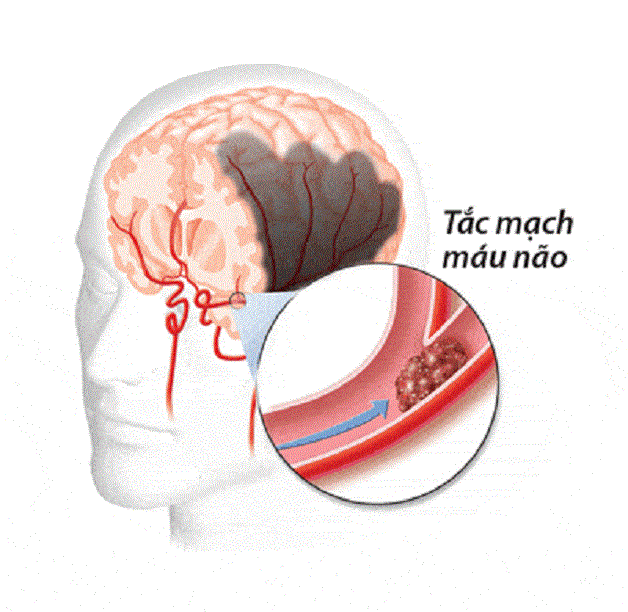 Cơ chế đột quỵ do lấp mạch từ tim, biểu hiện và chẩn đoán