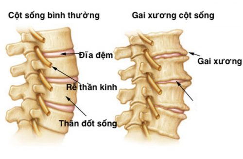 Cơ chế hình thành gai cột sống