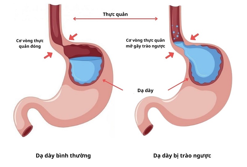 Cơ chế vi khuẩn HP gây trào ngược dạ dày, cách điều trị