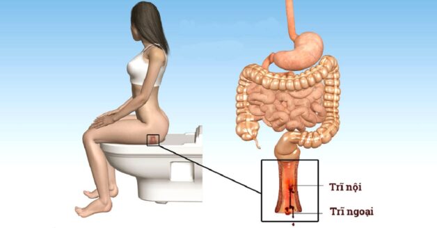 Có nên áp dụng cách trị bệnh trĩ tại nhà bằng thuốc dân gian?