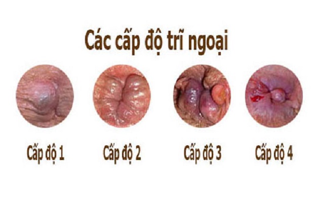 Có nên áp dụng cách trị bệnh trĩ tại nhà bằng thuốc dân gian?