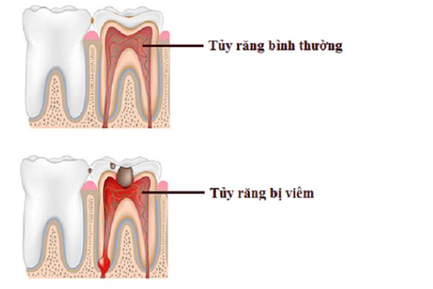 Có nên bọc răng sứ cho trẻ em?