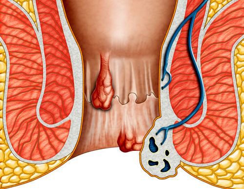 Có nên cắt trĩ hay không?