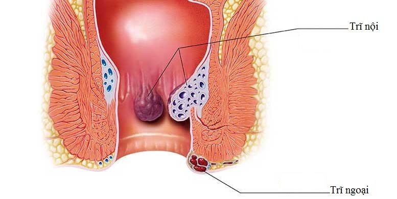 Có nên cắt trĩ không – Góc giải đáp