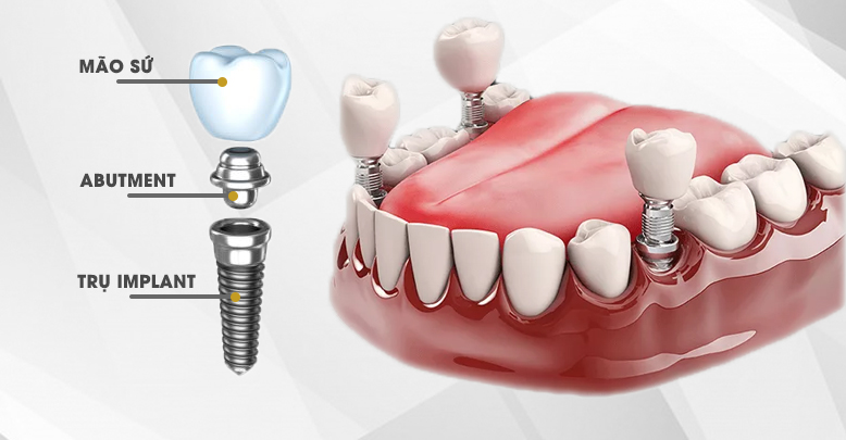 Có nên cấy ghép implant không? Cấy ghép implant có đau không?