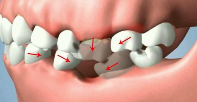 Có nên cấy ghép implant không? Làm implant bao lâu xong?