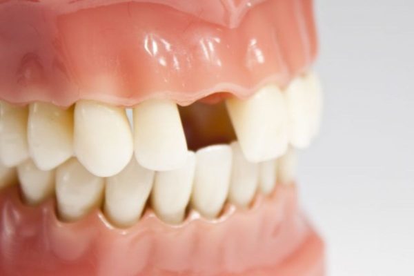 Có nên cấy ghép implant phục hình răng bị mất không?