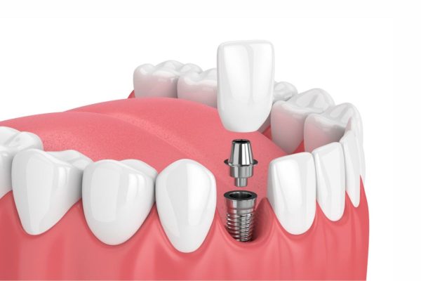 Có nên cấy ghép implant phục hình răng bị mất không?