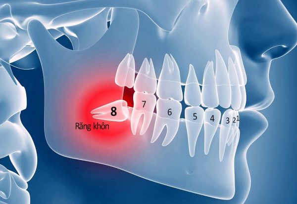 Có nên nhổ răng khôn không và các thắc mắc về nhổ răng