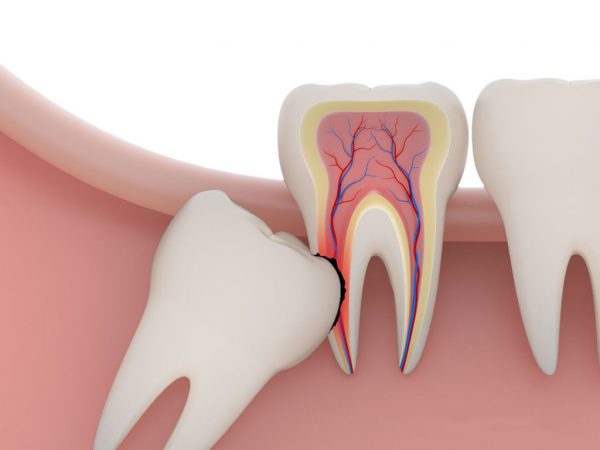 Có nên nhổ răng khôn không và các thắc mắc về nhổ răng