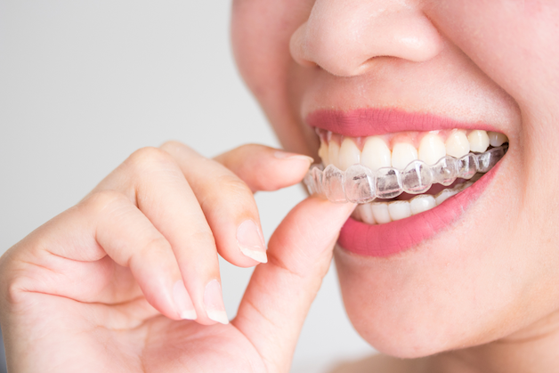 "Có nên niềng răng bằng phương pháp invisalign" là thắc mắc của rất nhiều người.