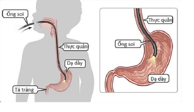 Có nên nội soi dạ dày cho trẻ em không?