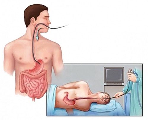 Có nên nội soi dạ dày?