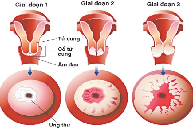 Có nên tầm soát ung thư cổ tử cung không? Khi nào nên tầm soát