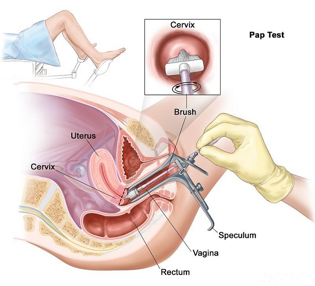 Có nên tầm soát ung thư cổ tử cung không?