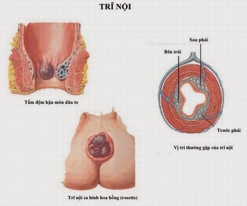 Có nên thắt búi trĩ không?