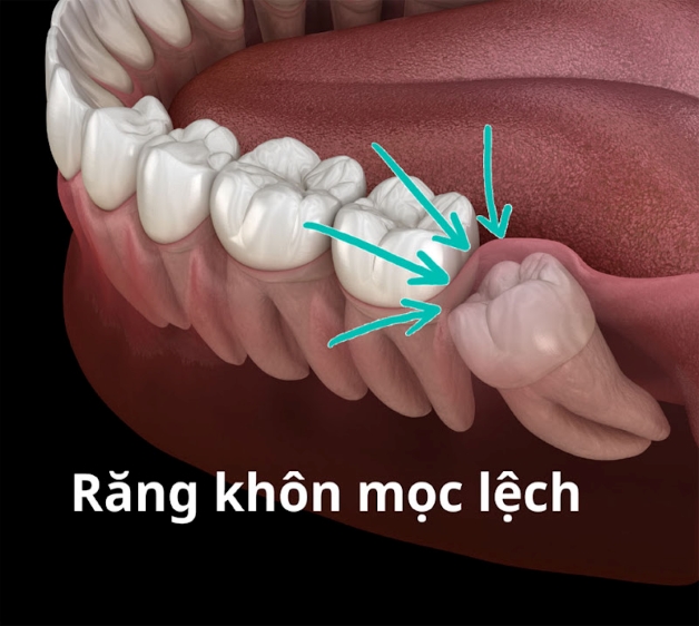 Có nên thực hiện hàn răng khôn khi bị sâu và những lưu ý