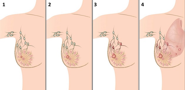 Có những cách tầm soát ung thư vú nào?