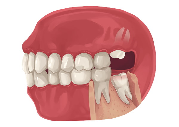 Có phải lúc nào cũng cần phải nhổ răng thừa không?