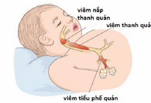 Có phải viêm tiểu phế quản sẽ phát triển thành hen suyễn?