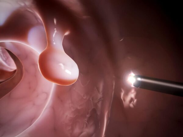 Có polyp ở đại tràng cần làm gì và điều trị như thế nào?