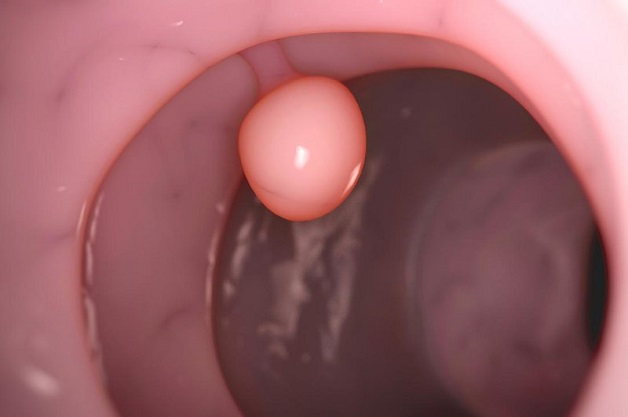 Có polyp trong đại tràng và cách điều trị